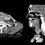 Preparación y procedimiento del examen TAC cervical: lo que debes saber