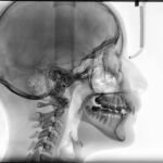Los beneficios del examen TAC cervical: Descubre por qué es importante para tu salud
